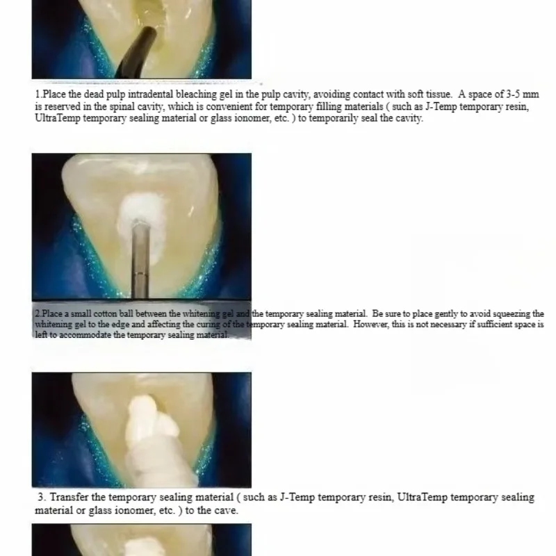 Bahan Restorasi Gigi, Pulp Mat - Teeth Whitening Effects ulasan dan harga